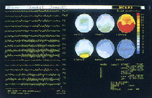 脳波イメージングＰＣソフト「アタマップ」のモニター画面
